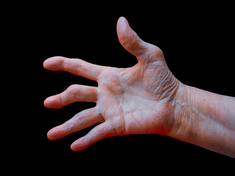 Human hand suffering rheumatoid arthritis